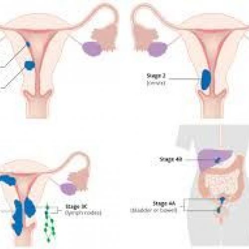 Stadiji karcinoma endometrija