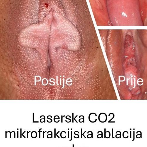 Dijagnostičke metode za GSM u osoba koje su preživjele rak dojke