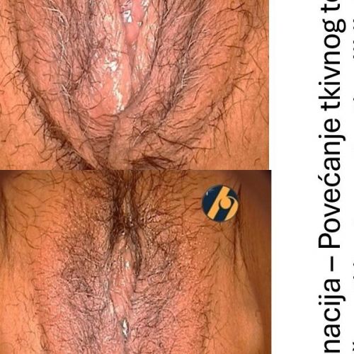 Laserska rejuvenacija intimnog područja u žena