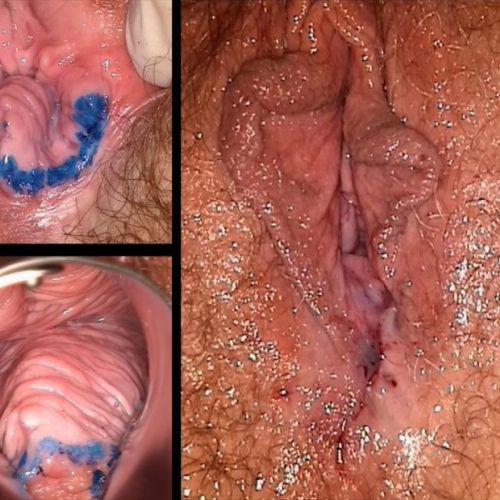 Laserska perineoplastika i vaginoplastika