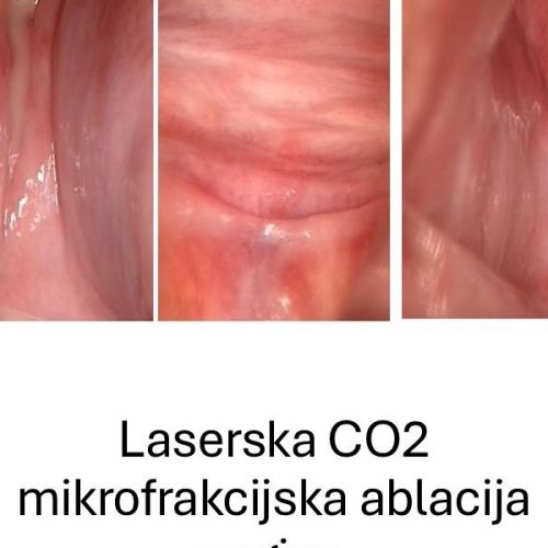 Frakcijski CO2 laser poboljšava simptome vulvo-vaginalne atrofije