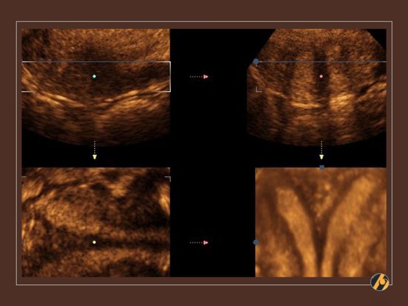 Ultrazvučna dijagnoza anomalija maternice