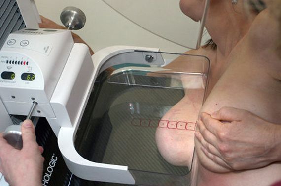 Manje mamografija – više slučajeva raka dojke